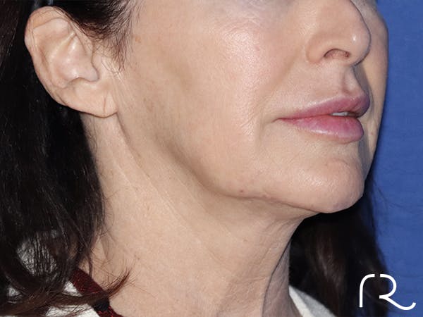 Neck Lift Before & After Gallery - Patient 121956054 - Image 1