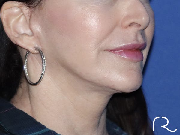 Facelift Before & After Gallery - Patient 121956022 - Image 2