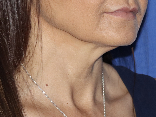 Neck Lift Before & After Gallery - Patient 121956055 - Image 1