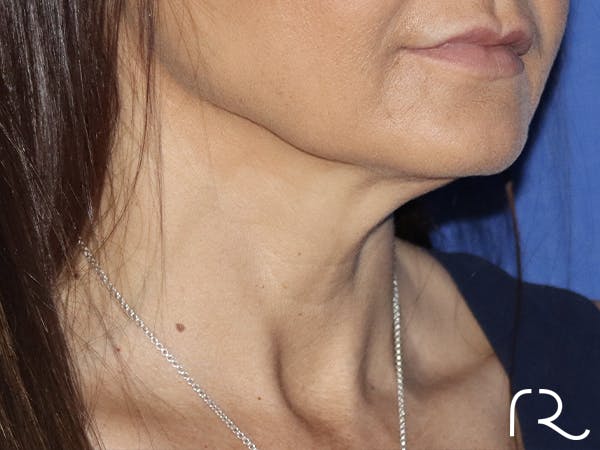 Neck Lift Before & After Gallery - Patient 121956055 - Image 1