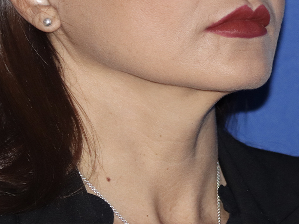 Facelift Before & After Gallery - Patient 121956023 - Image 2