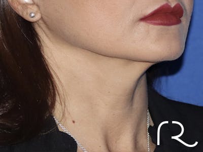 Facelift Before & After Gallery - Patient 121956023 - Image 2