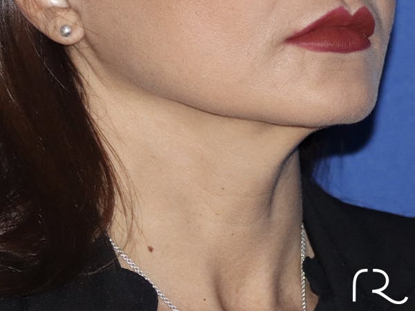 Facelift Before & After Gallery - Patient 121956023 - Image 2