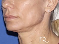 Facelift Before & After Gallery - Patient 121956024 - Image 1