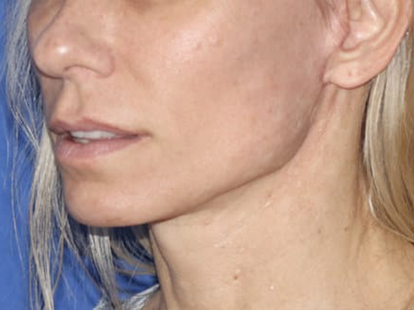Facelift Before & After Gallery - Patient 121956024 - Image 2