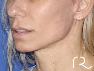 Neck Lift Before & After Gallery - Patient 121956056 - Image 2
