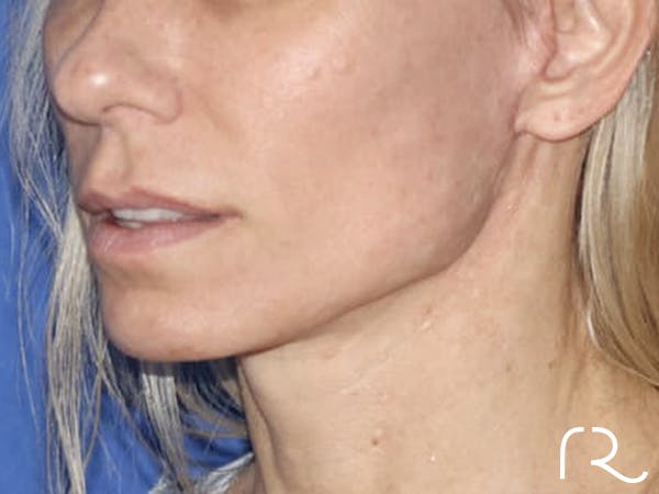 Neck Lift Before & After Gallery - Patient 121956056 - Image 2