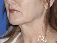 Neck Lift Before & After Gallery - Patient 121956057 - Image 1