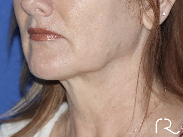 Neck Lift Before & After Gallery - Patient 121956057 - Image 1