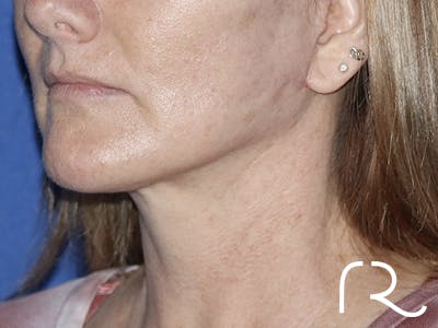 Neck Lift Before & After Gallery - Patient 121956057 - Image 2