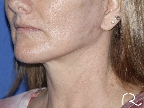 Neck Lift Before & After Gallery - Patient 121956057 - Image 2