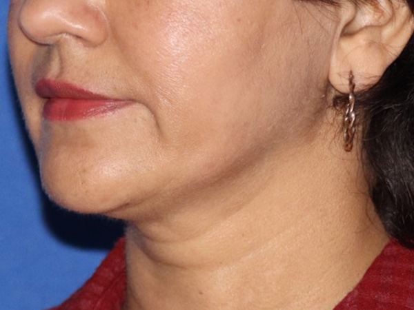Neck Lift Before & After Gallery - Patient 122707145 - Image 1