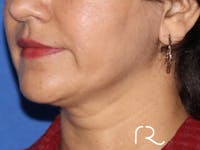 Neck Lift Before & After Gallery - Patient 122707145 - Image 1