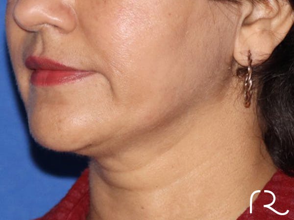 Facelift Before & After Gallery - Patient 122707113 - Image 1