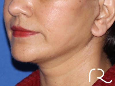 Facelift Before & After Gallery - Patient 122707113 - Image 2