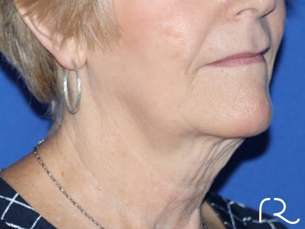 Neck Lift Before & After Gallery - Patient 122707144 - Image 1