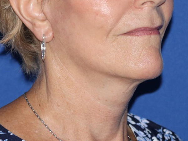 Neck Lift Before & After Gallery - Patient 122707144 - Image 2