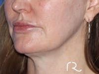 Facelift Before & After Gallery - Patient 122707111 - Image 1