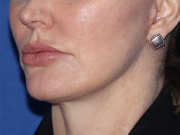 Neck Lift Before & After Gallery - Patient 122707143 - Image 2