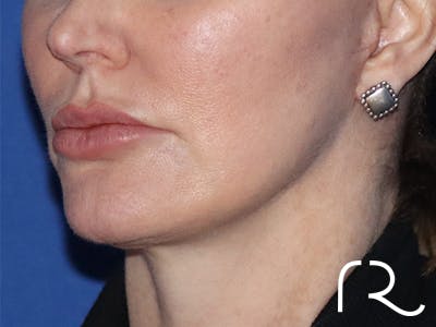 Neck Lift Before & After Gallery - Patient 122707143 - Image 2