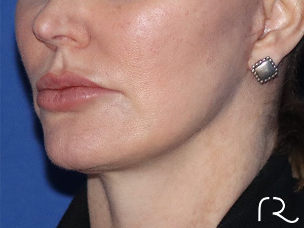 Neck Lift Before & After Gallery - Patient 122707143 - Image 2