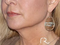 Facelift Before & After Gallery - Patient 122707110 - Image 1