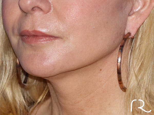 Facelift Before & After Gallery - Patient 122707110 - Image 2