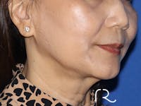 Facelift Before & After Gallery - Patient 122707109 - Image 1