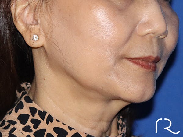 Neck Lift Before & After Gallery - Patient 122707141 - Image 1