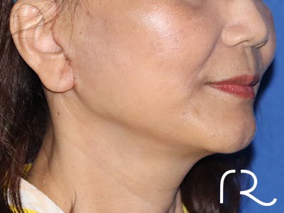 Facelift Before & After Gallery - Patient 122707109 - Image 2