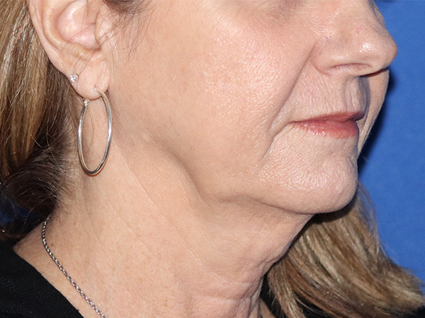 Neck Lift Before & After Gallery - Patient 122707140 - Image 1