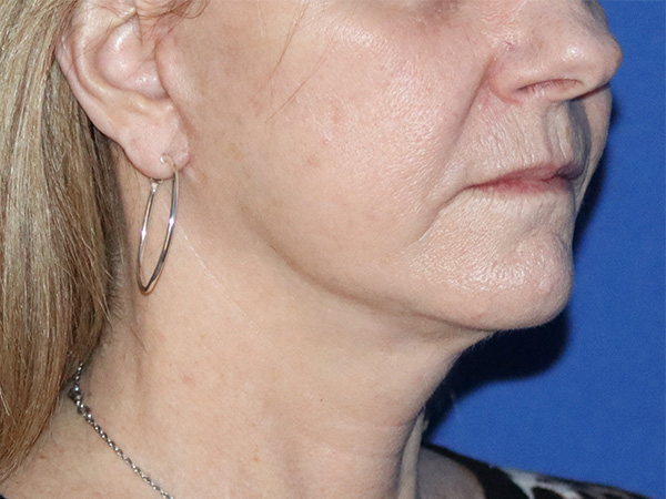 Facelift Before & After Gallery - Patient 122707108 - Image 2