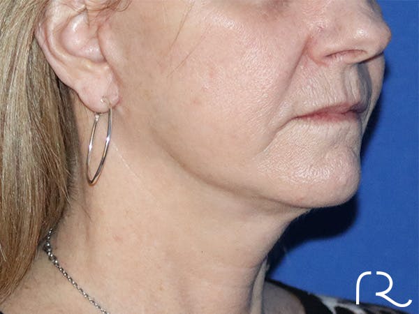 Facelift Before & After Gallery - Patient 122707108 - Image 2