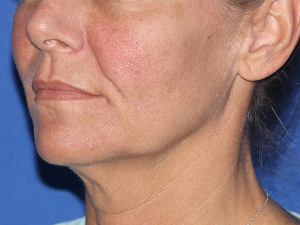 Neck Lift Before & After Gallery - Patient 122707139 - Image 1