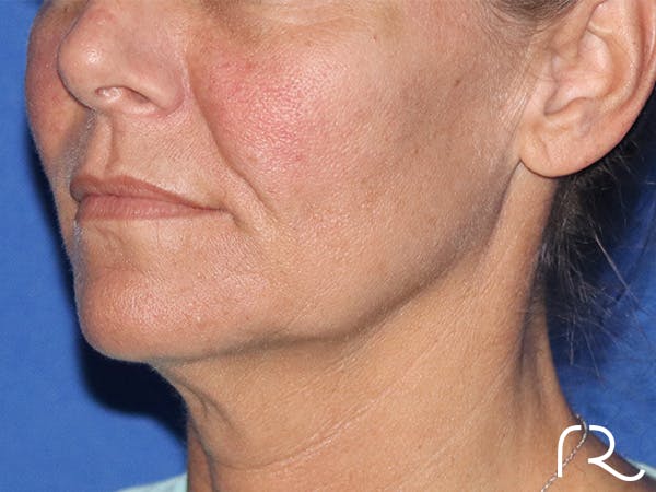 Facelift Before & After Gallery - Patient 122707107 - Image 1