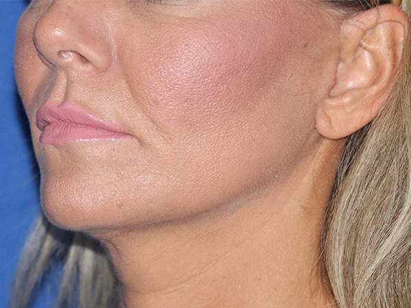 Neck Lift Before & After Gallery - Patient 122707139 - Image 2