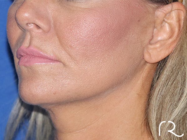 Facelift Before & After Gallery - Patient 122707107 - Image 2