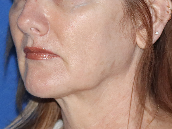 Neck Lift Before & After Gallery - Patient 122707138 - Image 1