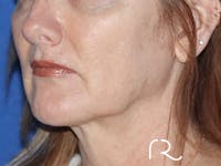 Neck Lift Before & After Gallery - Patient 122707138 - Image 1