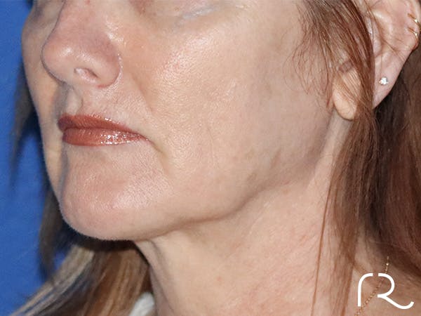 Facelift Before & After Gallery - Patient 122707106 - Image 1