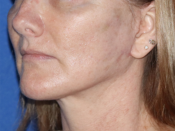 Facelift Before & After Gallery - Patient 122707106 - Image 2