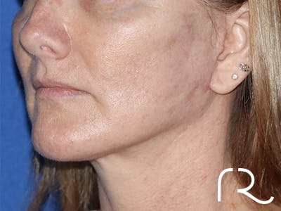 Neck Lift Before & After Gallery - Patient 122707138 - Image 2
