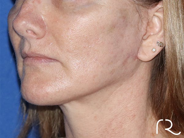 Facelift Before & After Gallery - Patient 122707106 - Image 2