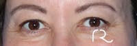 Eyelid Surgery Before & After Gallery - Patient 122707573 - Image 1