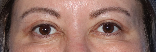 Eyelid Surgery Before & After Gallery - Patient 122707573 - Image 2