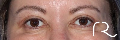 Eyelid Surgery Before & After Gallery - Patient 122707573 - Image 2