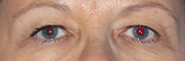 Eyelid Surgery Before & After Gallery - Patient 122707572 - Image 1
