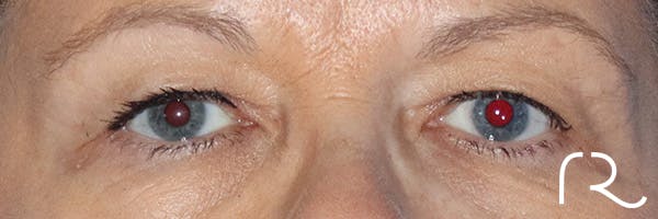 Eyelid Surgery Before & After Gallery - Patient 122707572 - Image 1