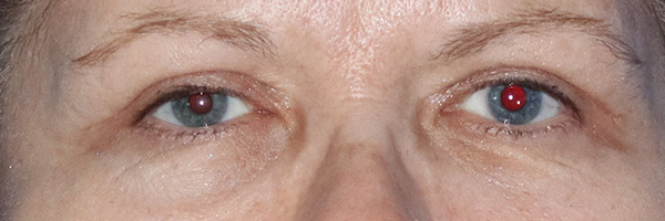 Eyelid Surgery Before & After Gallery - Patient 122707572 - Image 2