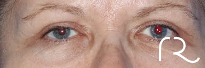 Eyelid Surgery Before & After Gallery - Patient 122707572 - Image 2